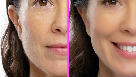 A woman's before and after beauty shot with the SimplySmooth